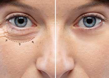 blepharoplasty before and after banner