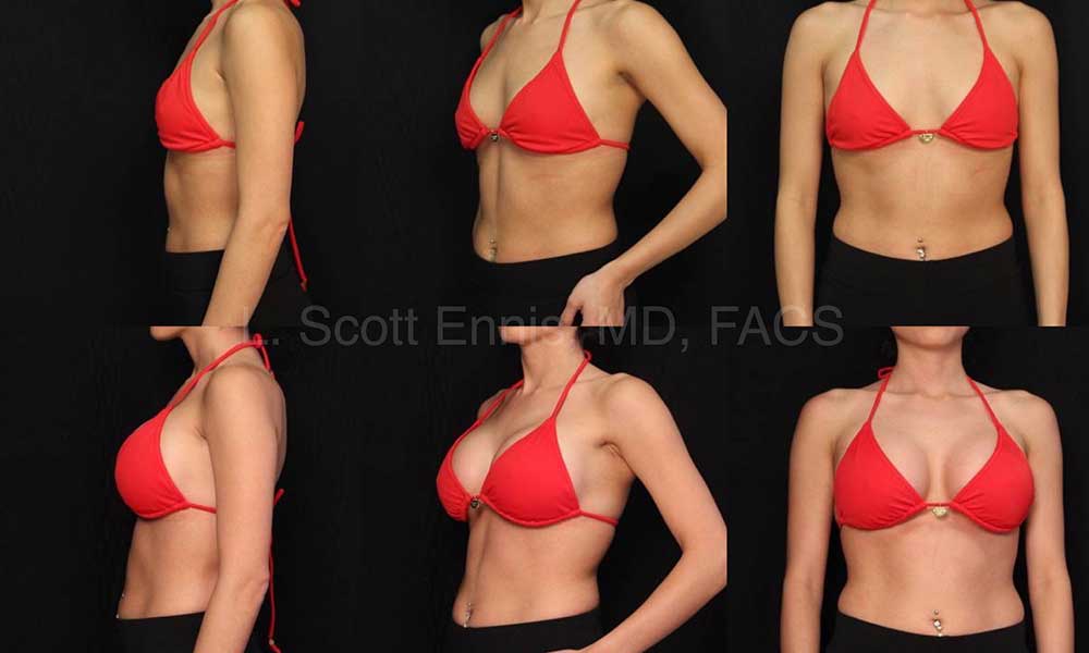 Transaxillary breast augmentation before and after