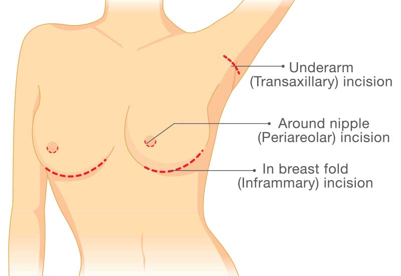 breast implant incision options diagram