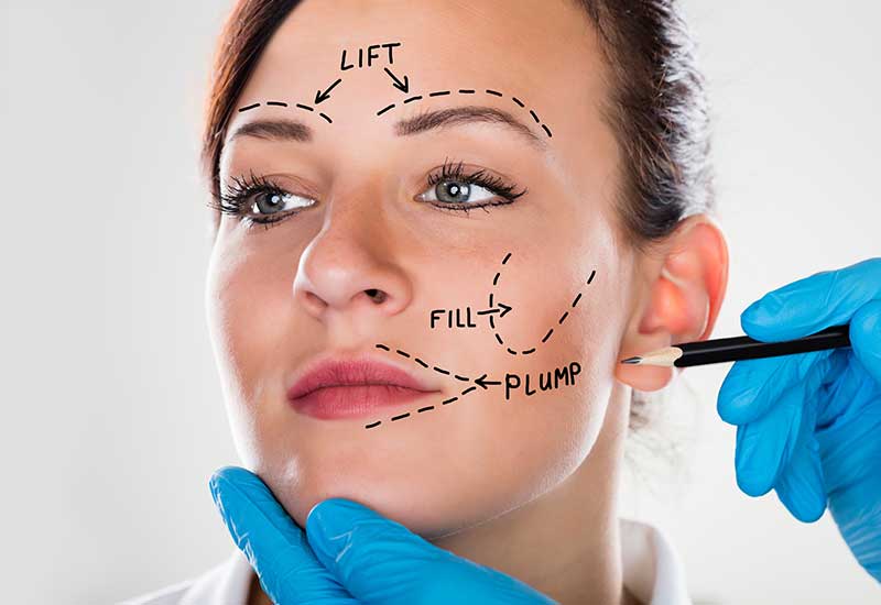 face mark-up for injectables and dermal filler treatment