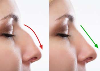 rhinoplasty before and after image