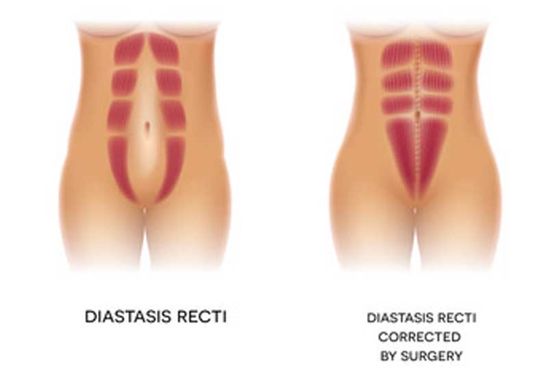 tummy tuck muscle illustration