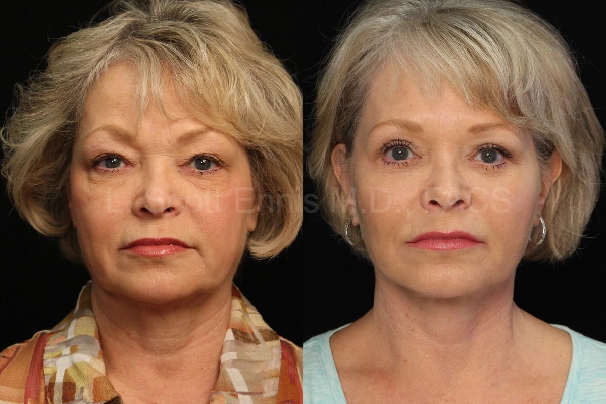 Dr. Ennis case 30018: before on the left and after on the right, deep plane facelift and lower blepharoplasty.