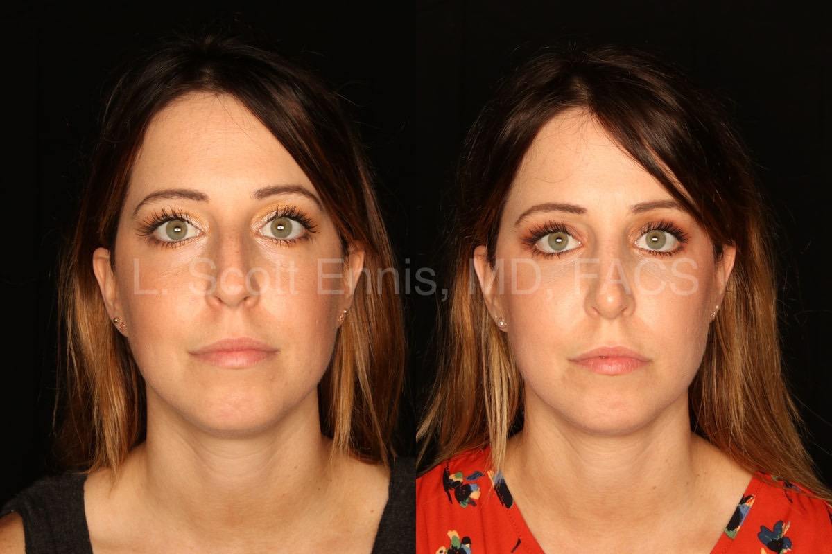 Original before-and-after comparison for rhinoplasty and bilateral lower blepharoplasty, Dr. Ennis case 50270.