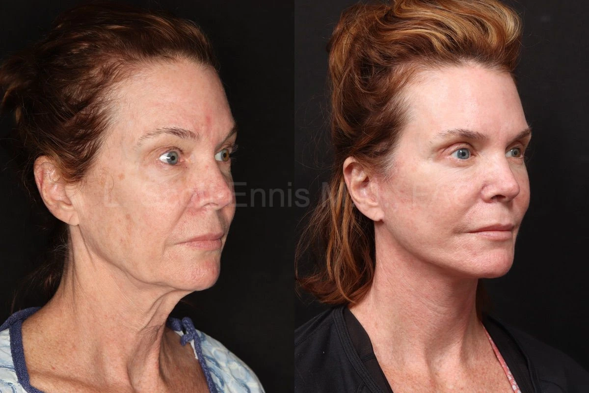 Before-and-after comparison for deep plane facelift with accompanying facial procedures, Dr. Ennis case 52289.